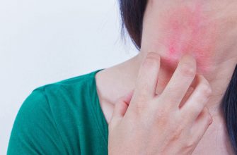 Allergie à l'argent - est-ce possible ?